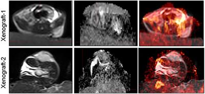 Prediction of pathological response grading for esophageal squamous carcinoma after neoadjuvant chemoradiotherapy based on MRI imaging using PDX